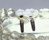 Implantate